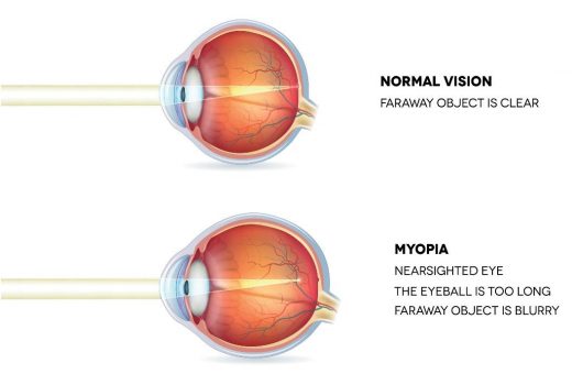 Normal vision v Myopia